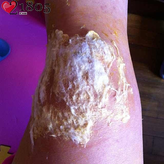 包扎棉花的絮絮头都粘在皮肤上了